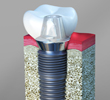 Dental Implants Chino California